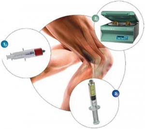 acp-therapie-schematische-darstellung