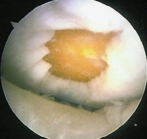 cartilage