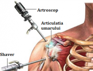 Shoulder-Arthroscopy
