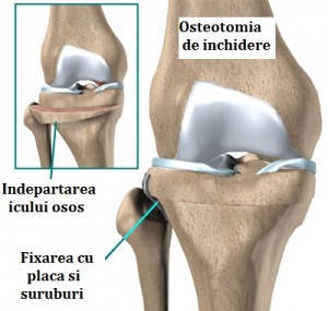 knee_tibosteo_surgery01