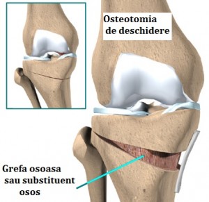 knee_tibosteo_surgery02