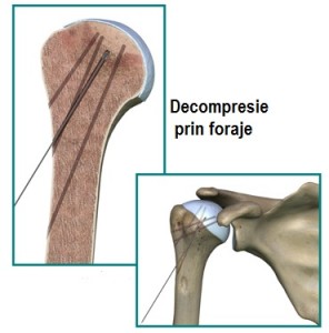 humeral_head_osteonecrosis_core_decompression_multi