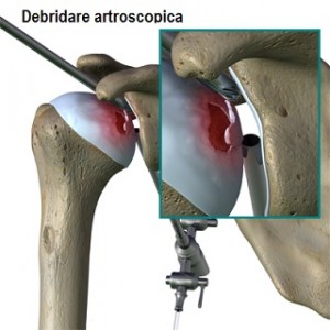 humeral_head_osteonecrosis_debridement