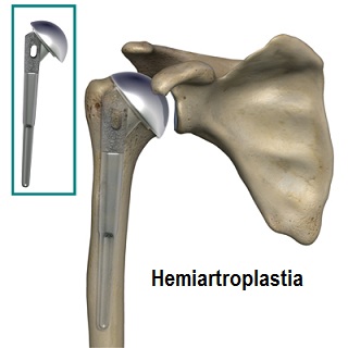 humeral_head_osteonecrosis_hemiarthroplasty