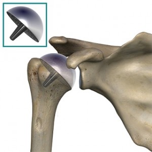 humeral_head_osteonecrosis_resurfacing