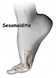 foot_sesamoiditis_intro01