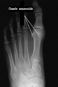 sesamoid_foot