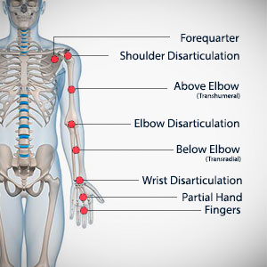 arm-amputation-types