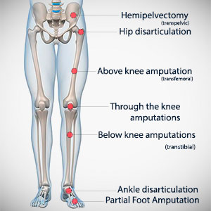 leg-amputation-types