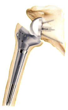 reverse-shoulder-arthroplasty